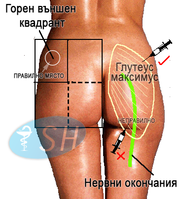 Схема на горния външен квадрант за интрамускулна инжекция в седалището